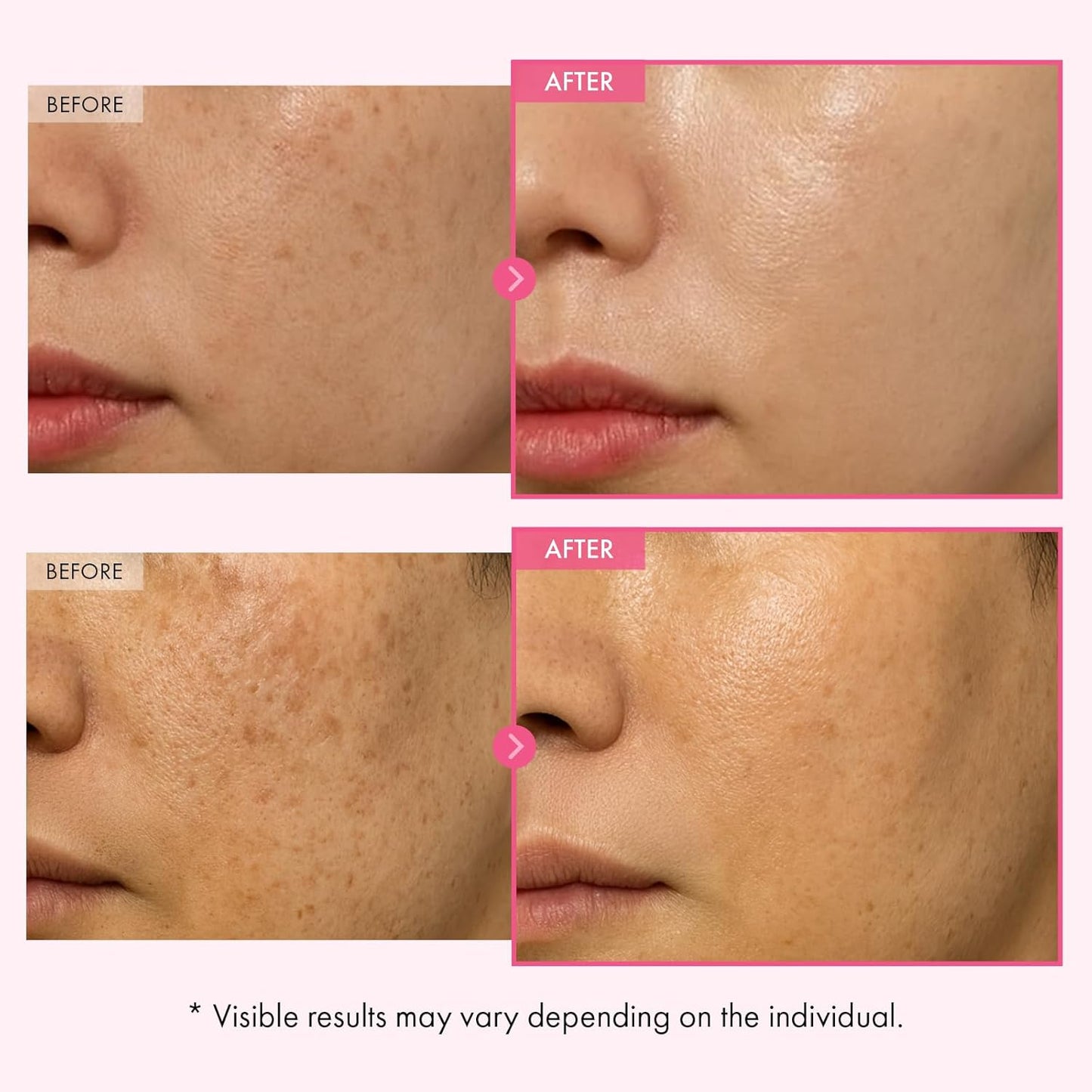 Arbutin 7% + Tranexamic Acid 4% Cream