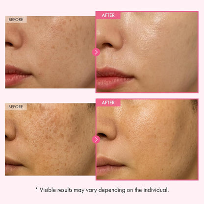 Arbutin 7% + Tranexamic Acid 4% Cream
